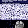 Oligodendroglioma: Clinical Presentation, Pathology, Molecular Biology, Imaging, and Treatment (PDF)
