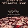 Cerebral Dural Arteriovenous Fistulas (PDF)