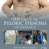The Cause of Pyloric Stenosis of Infancy (PDF)