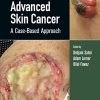 Advanced Skin Cancer: A Case-Based Approach (PDF)