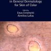 Dermoscopy in General Dermatology for Skin of Color (PDF)