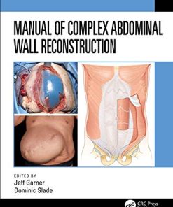 Manual of Complex Abdominal Wall Reconstruction (PDF)