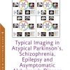 Typical Imaging in Atypical Parkinson’s, Schizophrenia, Epilepsy and Asymptomatic Alzheimer’s Disease (PDF)