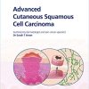 Fast Facts: Advanced Cutaneous Squamous Cell Carcinoma for Patients and their Supporters: Information + Taking Control = Best Outcome (PDF Book)
