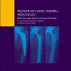 Revision of loose femoral prostheses with a stem system based on the ”press-fit” principle: A concept and its system of implants, a method and its results (PDF)