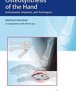 Osteosynthesis of the Hand: Instruments, Implants, and Techniques (EPUB)