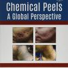 Chemical Peels: A Global Perspective (PDF Book)