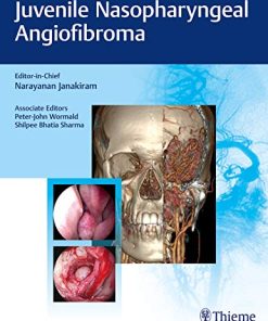 Juvenile Nasopharyngeal Angiofibroma (PDF)