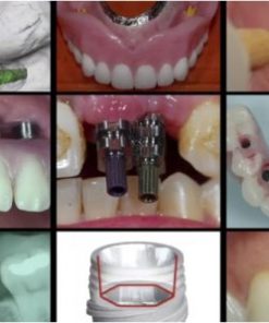 A-Z in Restorative Implant Dentistry Series (16 Lectures)