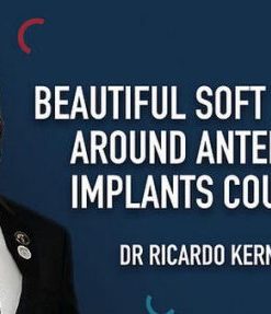 Beautiful Soft Tissue Around Anterior Implants