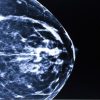 UCSF Breast Imaging and Digital Mammography 2014 (CME Videos)