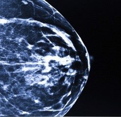 UCSF Breast Imaging and Digital Mammography 2014 (CME Videos)