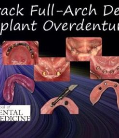 Full-Arch Dentistry – Implant Overdentures