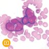 Current Concepts in Hematopathology 2022 (CME VIDEOS)