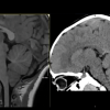 MRIOnline MRI Mastery Series: Infratentorial/Posterior Fossa Defects 2021 (CME VIDEOS)