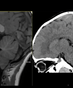 MRIOnline MRI Mastery Series: Infratentorial/Posterior Fossa Defects 2021 (CME VIDEOS)