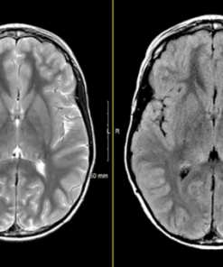 MRIOnline Imaging Mastery Series: Neurocutaneous Syndromes 2021 (CME VIDEOS)