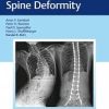 Neuromuscular Spine Deformity