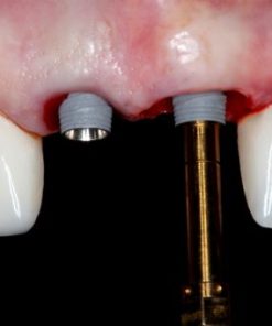 Online Residency Program: A-Z in Implant Dentistry