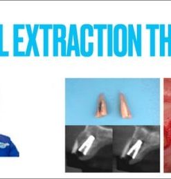 Partial Extraction Therapy Course