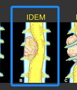 MRIOnline MRI Mastery Series: Intradural Extramedullary Lesions (IDEM) 2020 (CME VIDEOS)