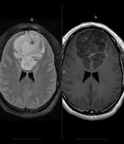 MRIOnline Imaging Mastery Series: Adult Glioma Imaging 2021 (CME VIDEOS)