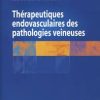 Thérapeutiques endovasculaires des pathologies veineuses (French Edition)