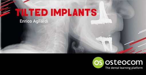 Tilted Implants: A complete surgical and theoretical guide to Tilted Implants