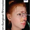 Non-Surgical Rhinoplasty (The PRIME Series) (EPUB)