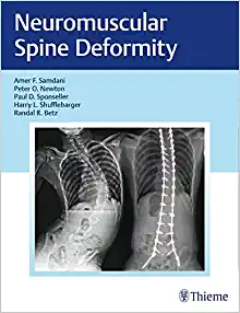 Neuromuscular Spine Deformity (EPUB)