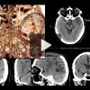 Imaging Acute Stroke: A Comprehensive Review for Clinical Practice 2023