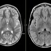 MRIOnline Mastery Series: Neurofibromatosis Type 1 (NF1) 2021 (CME VIDEOS)
