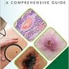 Skin Cancer: A Comprehensive Guide (PDF Book)
