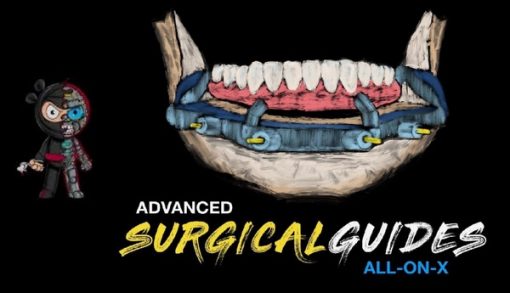 Implant Ninja, Advanced Surgical Guides – All on X – Dental Videos