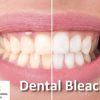 DentalXP Dental Bleaching (Course)