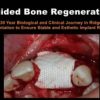 Guided Bone Regeneration: A 30 year Biological and Clinical Journey in Ridge Augmentation (Course)