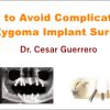 How to Avoid Complications in Zygoma Implant Surgery (Course)