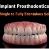 Implant Prosthodontics – From Single to Fully Edentulous Solutions (Course)