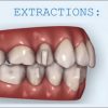 Invisalign and Extractions (Course)