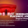 OHI-S Immediate Implant Placement and Loading Surgical Protocols (Course)