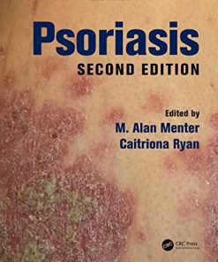 Psoriasis, Second Edition (PDF Book)