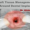 Soft Tissue Management Around Dental Implant, a Novel Approach (Course)