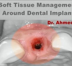 Soft Tissue Management Around Dental Implant, a Novel Approach (Course)