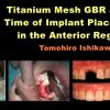 Titanium Mesh GBR at the Time of Implant Placement in the Anterior Region (Course)