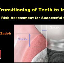 Transitioning of Teeth to Implants: Risk Assessment for Successful Outcome (Course)
