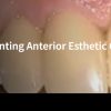 Classic Collection: Cementing Anterior Esthetic Crowns