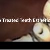 Classic Collection: Endo Treated Teeth Esthetic Management