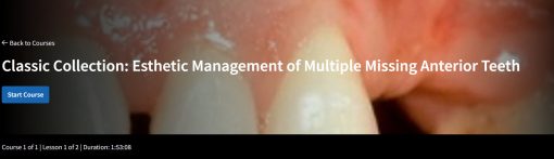 Classic Collection: Esthetic Management of Multiple Missing Anterior Teeth