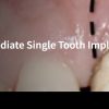Classic Collection: Immediate Single Tooth Implants