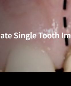 Classic Collection: Immediate Single Tooth Implants